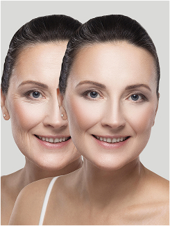 Benefits Of Dermal Fillers01