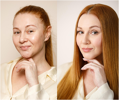 Benefits Of Dermal Fillers02