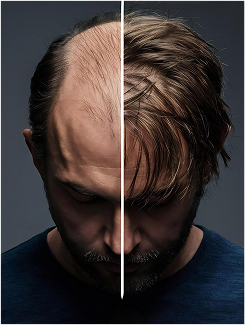 Benefits Of Prp Prfm02