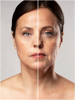 Fibroblast Skin Tightening Benefit Of Febral02